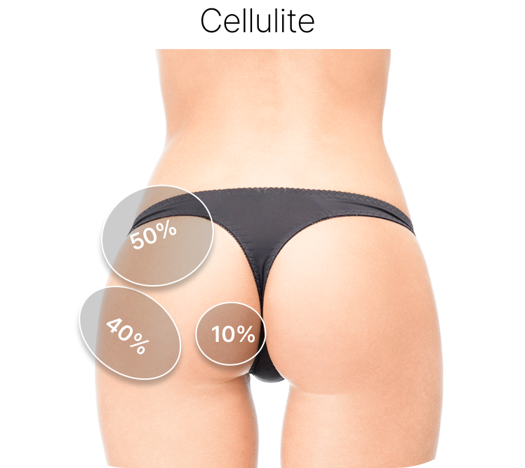 Hip Cellulite